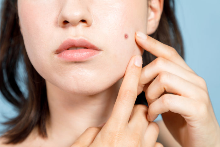 acne på tør hud