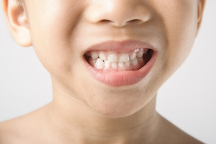 pletter på børns tænder
