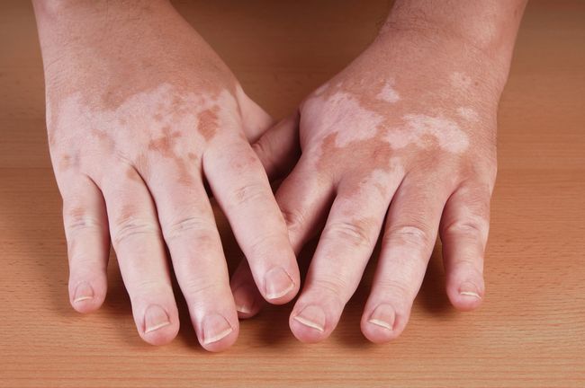 vitiligo kan helbrede