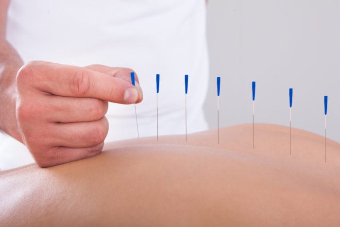 akupunktur lindrer smerter