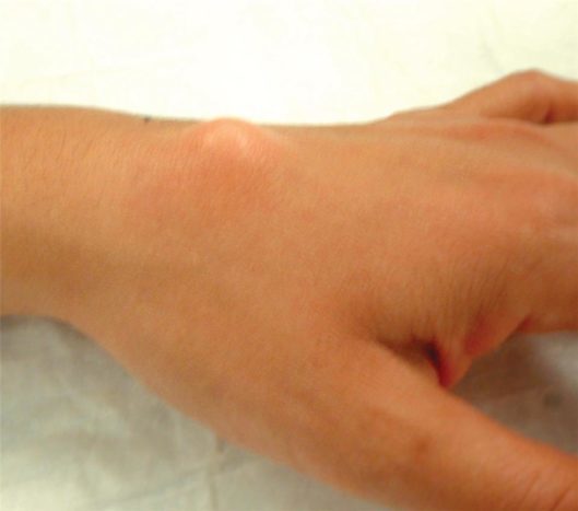Øvre håndledspole ganglion cyste (kilde: American Society for Hand surgery)
