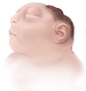 forhindre anencephaly