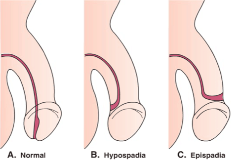 penis hullet er ikke normalt, episoder af hypospadier
