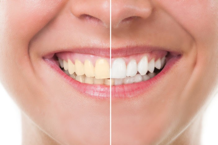 Bivirkninger af hvidt tænder med blegning