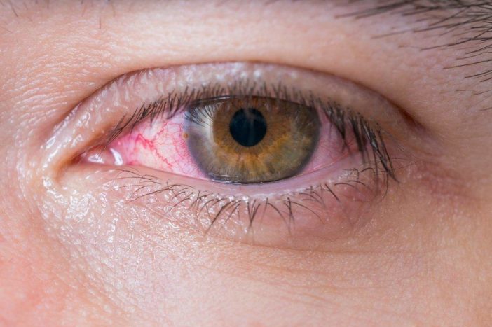 allergisk røde øjet konjunktivitis
