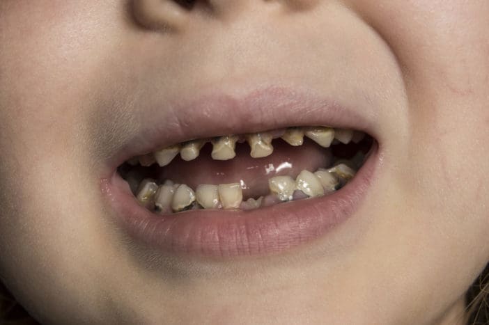 baby flaske tandbortfald for børns tandbortfald