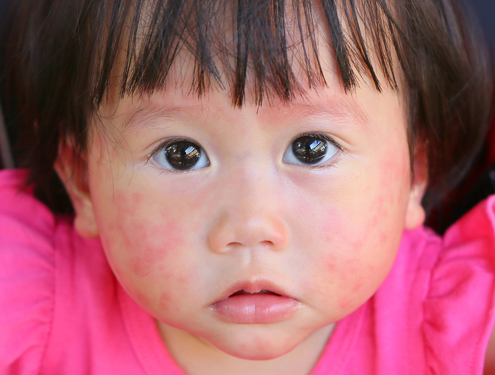 karakteristika for babyer allergiske over for komælk