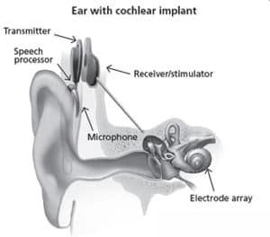 cochlear implantat enhed