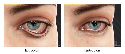 ektropion af øjenlågsforstyrrelser