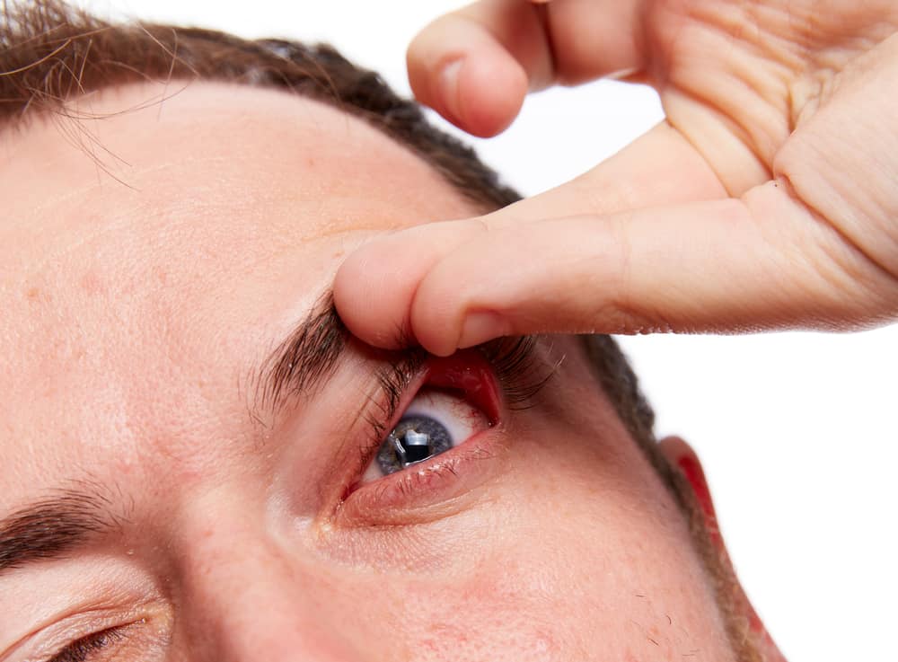 floppy eyelids hængende øjenlågs syndrom