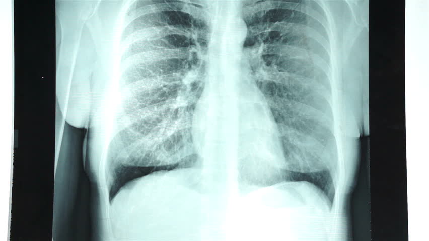 bryst røntgen