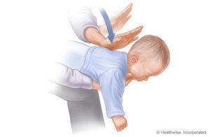 Skridt til at hjælpe kvælning babyer (1-3) kilder: www.webmd.com