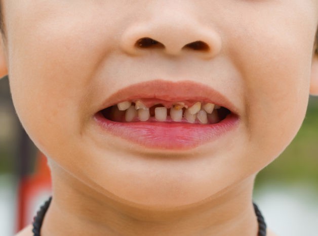 skader på børns tænder
