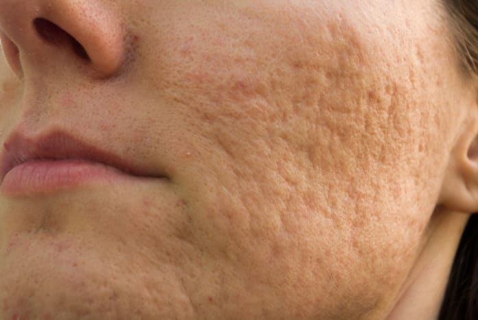 hvordan man slippe af med pockmark acne ar