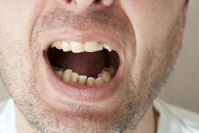 hvordan man forhindrer tandsten